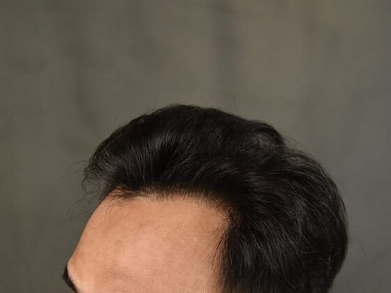 After FUE Hair Restoration: Case 18's procedure