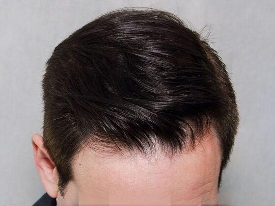 After Hair Transplant